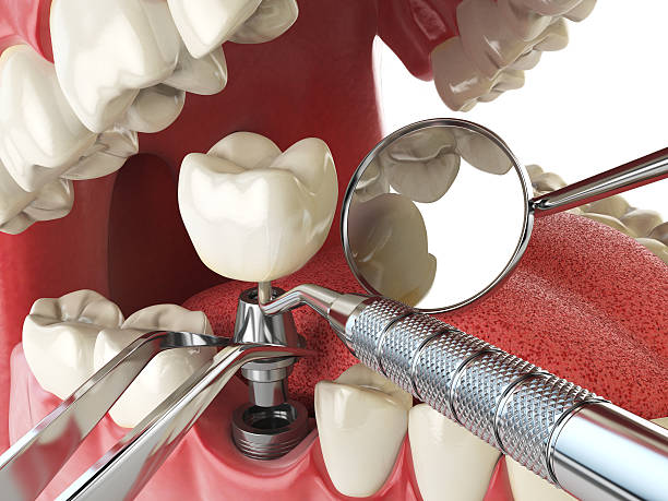 Best Emergency Tooth Extraction in Harrison, OH